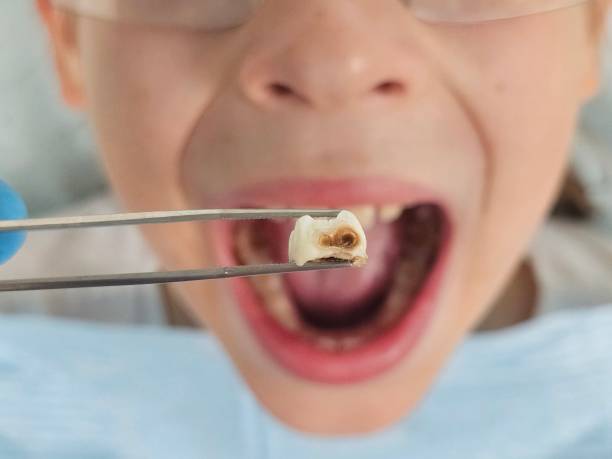 Best Broken or Cracked Tooth Emergency Dentist in Martinez, CA